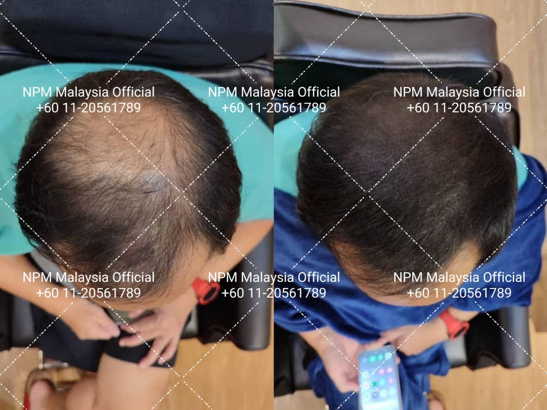 Male pattern baldness - Crown area restoration, NPM Malaysia, NPM Malaysia hair restoration, NPRA KKM approved hair treatment, NPRA KKM certified hair treatment, Advanced Follicular Unit Simulation (FUS)