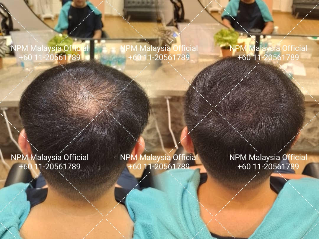 Perbandingan sebelum dan selepas pelanggan, NPM Malaysia, NPM Malaysia hair restoration, NPRA KKM approved hair treatment, NPRA KKM certified hair treatment, Hair density solution Malaysia