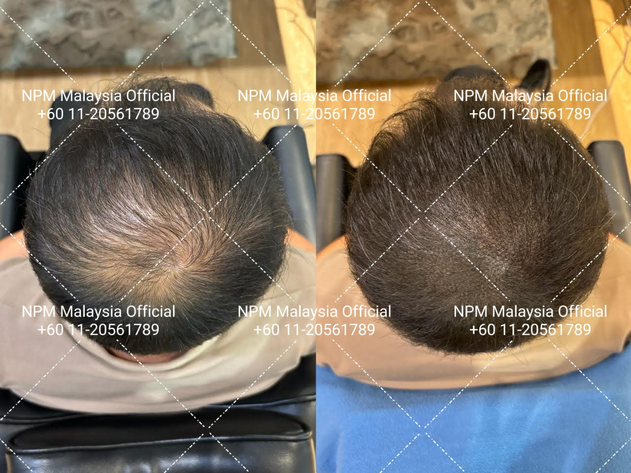 Hairline restoration - Natural looking results, NPM Malaysia, NPM Malaysia hair restoration, NPRA KKM approved hair treatment, NPRA KKM certified hair treatment, Bio-Photonic Scalp Stimulation (BPSS)