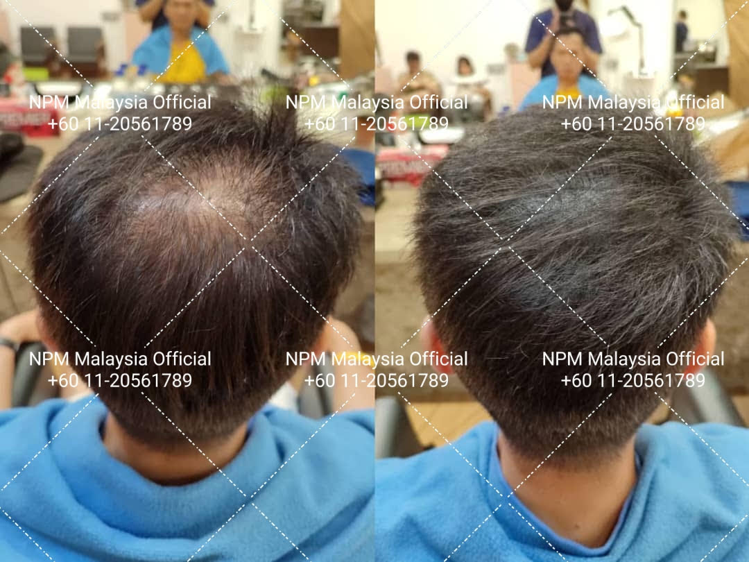 Overall hair density improvement, NPM Malaysia, NPM Malaysia hair restoration, NPRA KKM approved hair treatment, NPRA KKM certified hair treatment, Scalp stimulation for hair growth