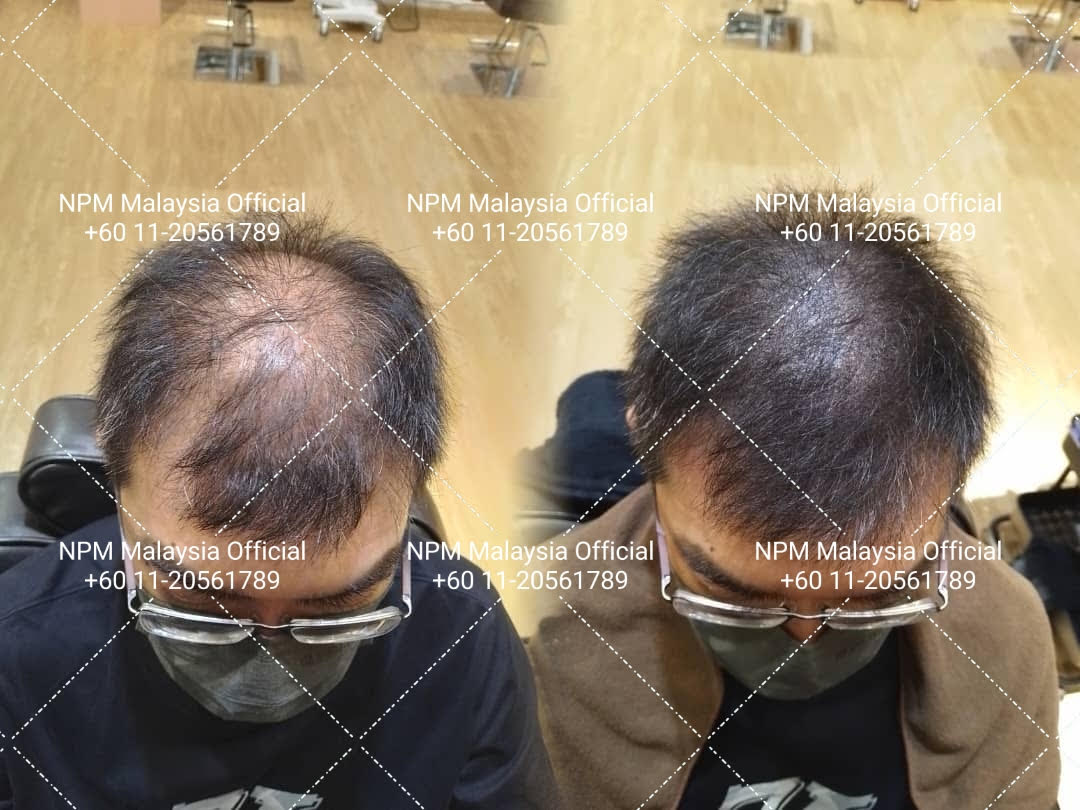 Temple area restoration - Professional results, NPM Malaysia, NPM Malaysia hair restoration, NPRA KKM approved hair treatment, NPRA KKM certified hair treatment, male pattern baldness solution Malaysia