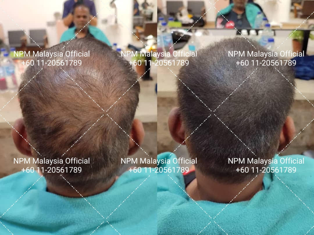 Scalp coverage - Full transformation, NPM Malaysia, NPM Malaysia hair restoration, NPRA KKM approved hair treatment, NPRA KKM certified hair treatment, Male pattern baldness Malaysia